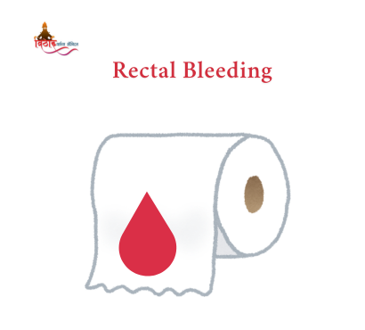Why Rectal Bleeding Should Never Be Ignored: Possible Causes and Treatments