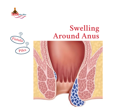 Swelling Around Anus: When It’s More Than Hemorrhoids